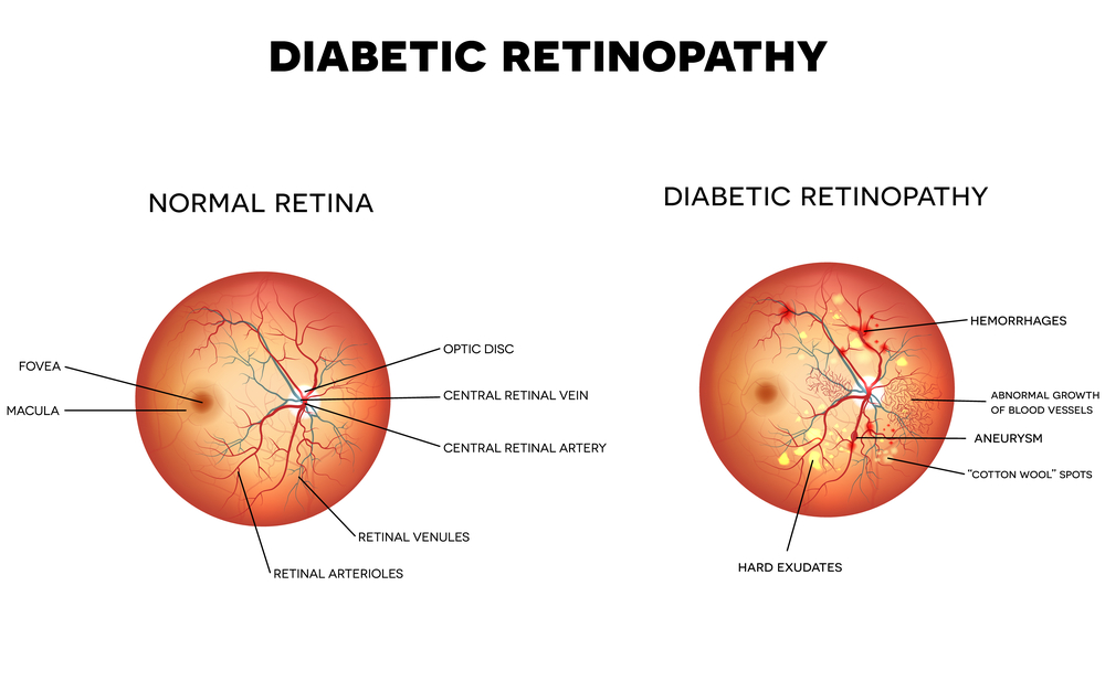 Diabetic Eye Service Optometrist in Naples, FL
